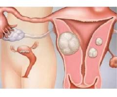 Understanding Which Size of Fibroid Is Considered Normal and Its Impact on Health