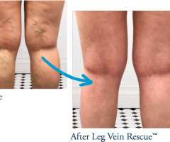 Understanding Chronic Venous Insufficiency