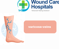 Best Venous Ulcer treatment in Hyderabad | Kukatpally | KPHB - WCH