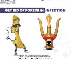 KSR Stapler Circumcision in hyderabad | Bangalore - Circumcure