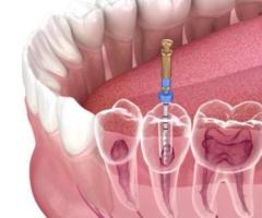 Root Canal Treatment Penrith