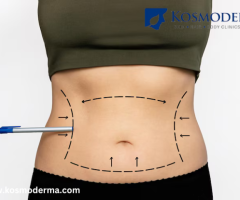 Best Liposuction Surgery in Bangalore - Kosmoderma Skin Clinic