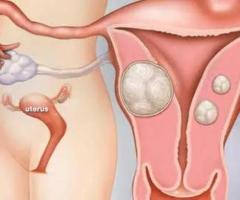 Which Size of Fibroid Is Normal? Understanding Fibroid Growth and Health Implications