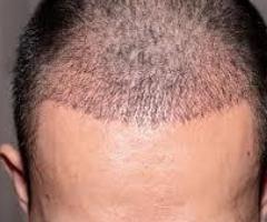 Comprehensive Guide to Hair Transplant Surgery Cost in Noida, with Dr. Amit Gupta