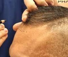 Understanding the Different Types of Hair Transplant Procedures