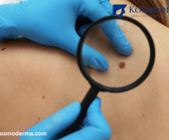 Mole Removal Clinic & Wart Removal Specialist in Delhi | Expert Skin Care at Kosmoderma