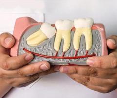 Top Benefits of Choosing Professional Wisdom Tooth Removal Services in Mulund