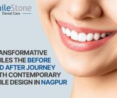 Best Smile design in Nagpur