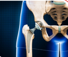 Hip Replacement Surgery: Advanced Techniques for a Better Quality of Life, In Akwa Ibom, Nigeria