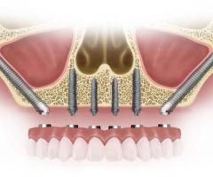 Zygomatic Implants in Mulund: The Best Treatment for Severe Tooth Loss - 1