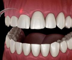 Laser Gum Sculpting in Farmington, UT: Transform Your Smile with Meru Orthodontics