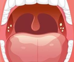 What is a Laser Frenectomy Procedure ?