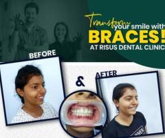 Affordable Braces and Pitts21 Braces in Nagaram, ECIL, AS Rao Nagar