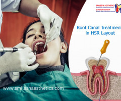 Save Your Smile! Specialized Root Canal Treatment in HSR Layout