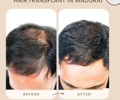 Hair Transplant in Madurai | Renew Hair & Skin Care