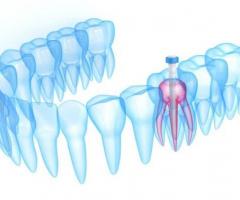 Root canal in Madurai - 1