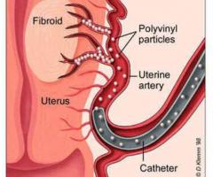 What are the benefits and side effects of Uterine Artery Embolization | Medanta - 1