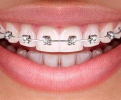Teeth Alignment Braces In Madurai