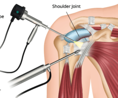 Get Your Treatment of Your Shoulder By Arthroscopy in Delhi