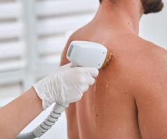 Smooth & Hassle-Free Skin | Laser Hair Removal for Men