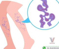 Varicose Veins Treatment in Hyderabad | Vascularhyd