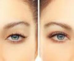 Upper Eyelid Lift Surgery