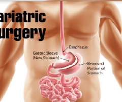 San Francisco Bariatric Surgery Procedures