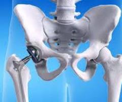 Hip Replacement Surgery: A Path to Pain Relief and Improved Mobility, In Sudan