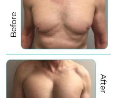 Chest Implants for Men Guys: A Path to Enhanced Masculine