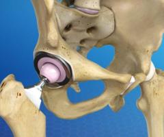 Hip Replacement Surgery: Your Path to an Active, Pain-Free Life, In Kenya