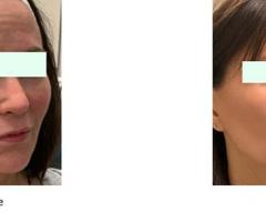 How Long Does Recovery Take After a Thread Lift for Eyes or Browlift?