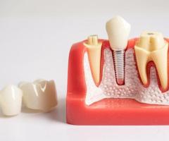 Say Goodbye to Tooth Pain! Get Professional Root Canal Treatment Near You!