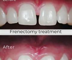 Looking for Frenectomy treatment?