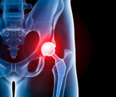 The Benefits of Using Assistive Devices After Hip Replacement Surgery, In Kenya