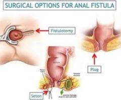 Best Doctor For Fistula Treatment in Indirapuram