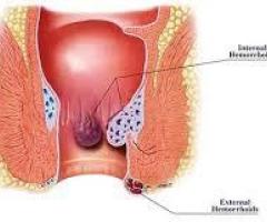 Pilonidal Sinus treatment in Ghaziabad