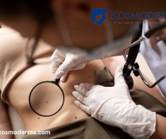 Effective Skin Tag Removal in Delhi | Restore Your Skin's Smoothness at Kosmoderma