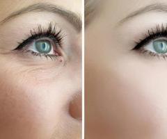 Under Eye Laser Treatment in Delhi at Eyeroots Eye Clinic