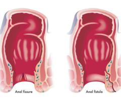 Best Ayurvedic Anal Fistula Treatment in Ghaziabad – JraVeda Ayurveda Clinic