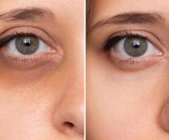 Erase Tired Eyes: Experience Our Under Eye Peel