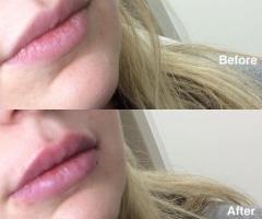 Non-Surgical Nose and Lips Augmentation in Richmond