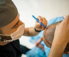 What is the best age for hair transplant?