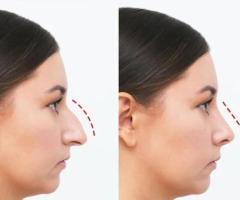 Get a Nonsurgical Nose Job Done by Expert Dr. with No Side Effects or Pain