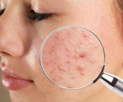 Acne Treatment in Lucknow