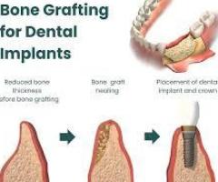 Best Bone Graft Manufacturer in India – Medoja Biomaterials