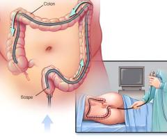 Colonoscopy test center in Delhi | Easy book my lab