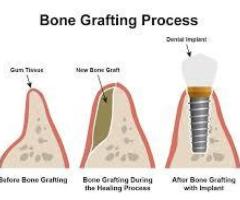 Looking for the Best Bone Graft Manufacturer in India?