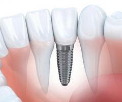 Dental Implants Price - 1