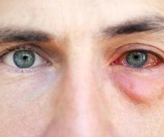 Eye Allergy Treatment in Delhi