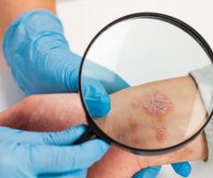 Psoriasis Treatment in India: Hope for Skin Condition Sufferers